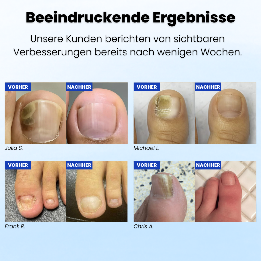 Ruliva™ Nagelpilz Pflaster