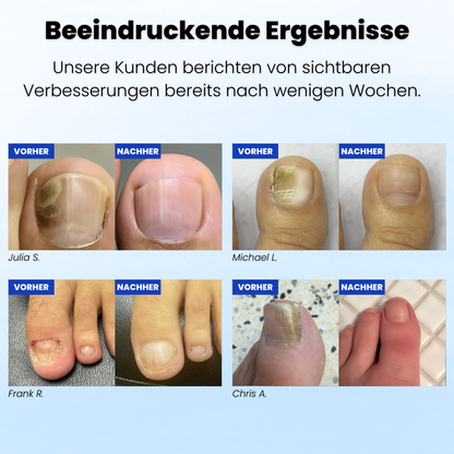 Ruliva™ Nagelpilz Pflaster